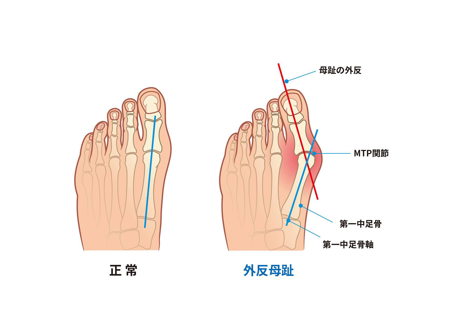 ⑥ 症状について知る（外反母趾）とは？