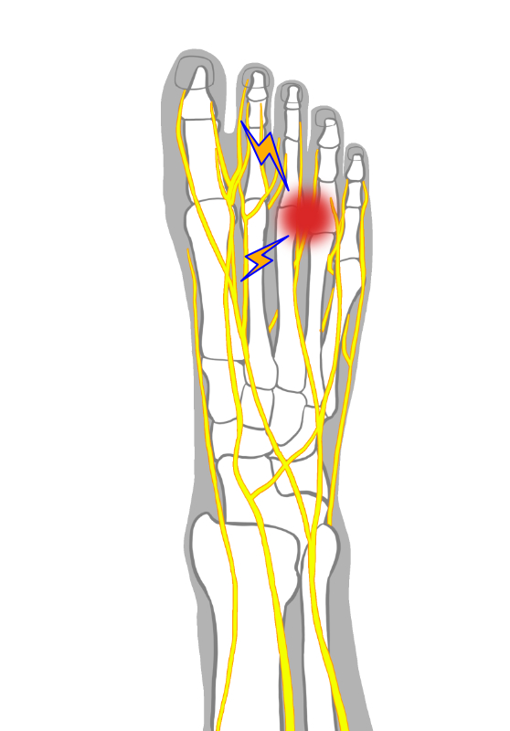 ⑥ 症状について知る（モートン病）とは？