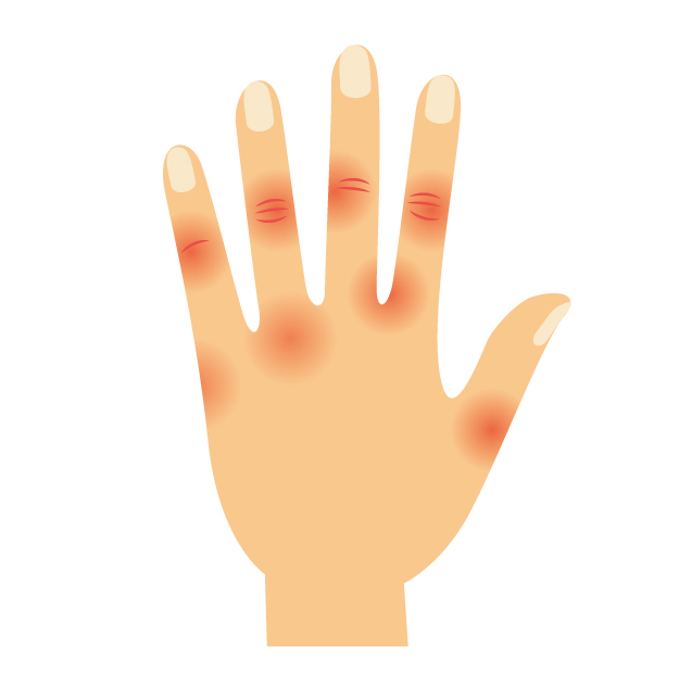 ⑦ 選ばれる理由（へバーデン結節）施術イメージ